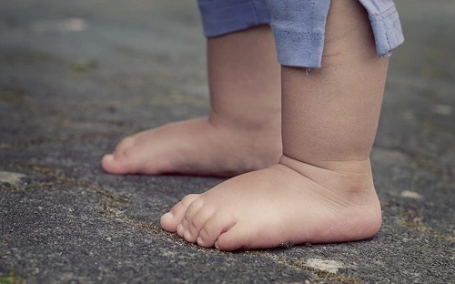 تشخیص کف پای صاف در کودکان