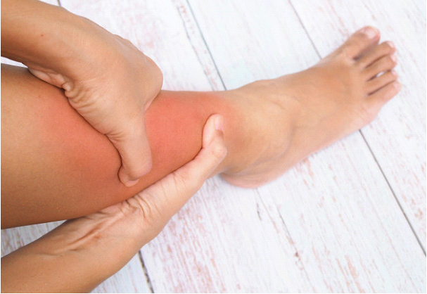 آیا ورم پا خطرناک است؛ خطر ابتلا به آمبولی ریوی در صورت ایجاد لخته خون در عروق عمقی و ورم پا 