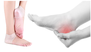 چگونگی درمان درد کف پا و پاشنه و زمان مناسب برای جراحی آن
