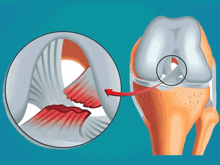 هر چه باید درباره علائم پارگی رباط صلیبی بدانید + خطرات پارگی