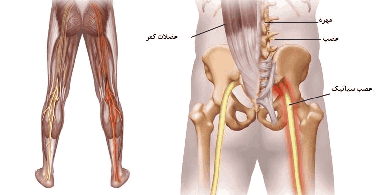 چه چیزهایی برای سیاتیک مضر است؟ راهنمای جامع مراقبت